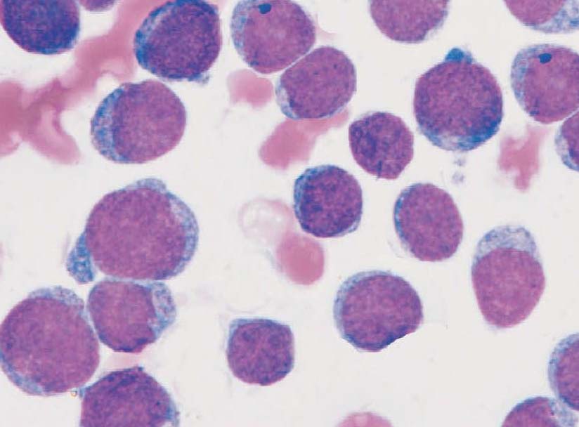 急性原粒细胞白血病未分化型-M1型